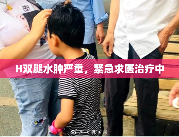 H双腿水肿严重，紧急求医治疗中